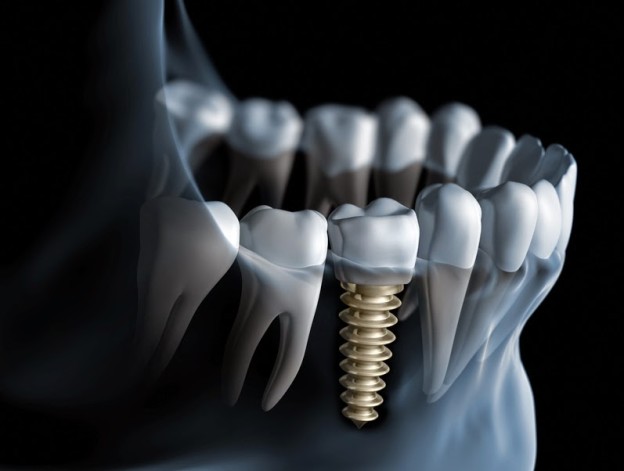 Οδοντικά εμφυτεύματα: Τι είναι πού και πότε χρησιμοποιούνται; Έρευνα κόστους οδοντικής εμφύτευσης στην Ελλάδα!