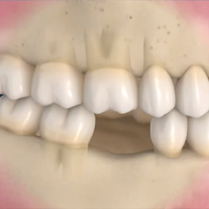 Συνέπειες, όταν το χαμένο δόντι δεν αντικαθίσταται (Βίντεο)